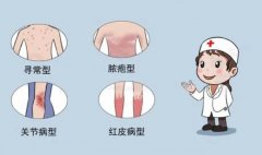 南京皮研所银屑病科正规吗
